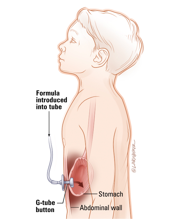 Gastrostomy tube (G-tube)