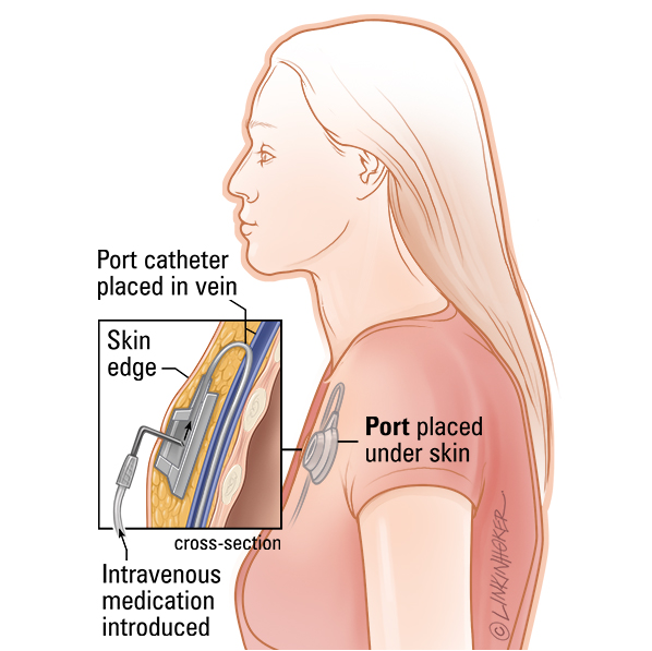 Port-a-cath®