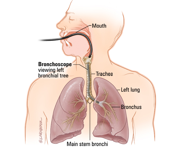 Bronchoscopy