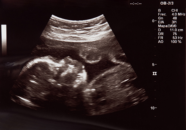 Ultrasound