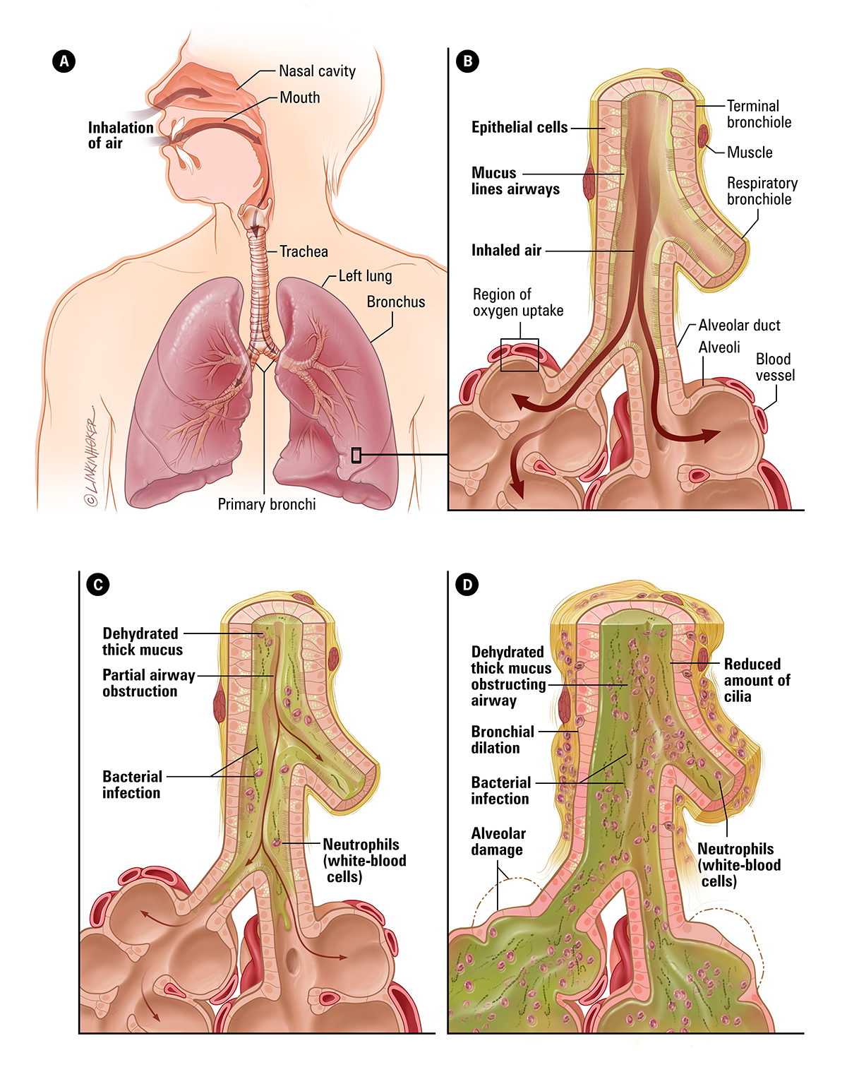 Normal lung airway compared with lung airway with CF