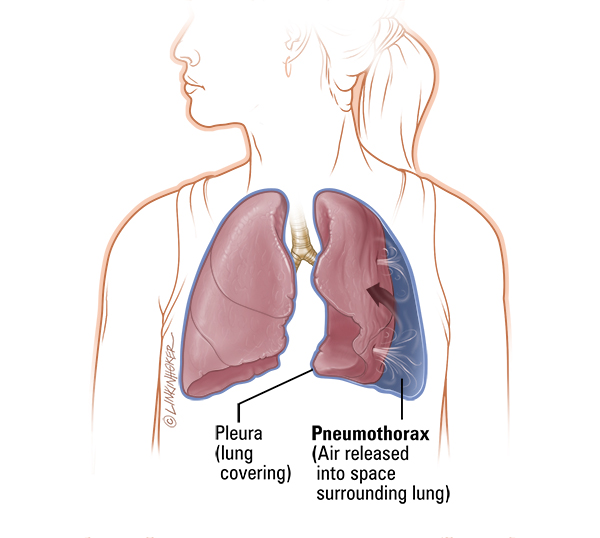 Effects of CF - Johns Hopkins Cystic Fibrosis Center